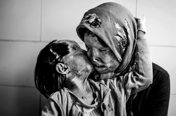 Matka a jej trojročná dcéra po útoku ich otca/manžela kyselinou.