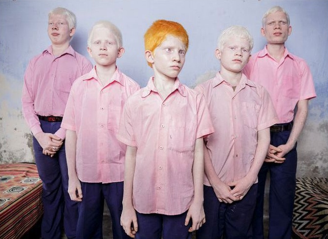 Slepí albínci v ich škole pre slepcov v Indii, rok 2013.