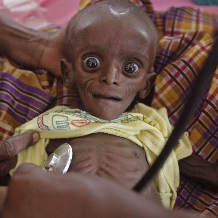 Africký chlapček bojuje s podvýživou.