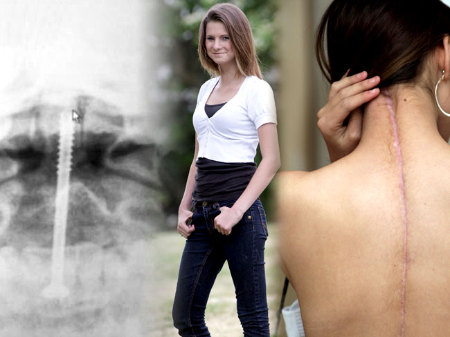 V roku 2009 utrpela Katrina Burgess pri autonehode rozsiahle zlomeniny a zranenia chrbtice. Lekári jej dali kosti dokopy pomocou 11. titánových kolíkov, ktoré mala v krku, chrbtici a nohách. Je až neuveriteľné, že sa po piatich mesiacoch úplne zotavila a dnes pracuje pre modelingovú agentúru.